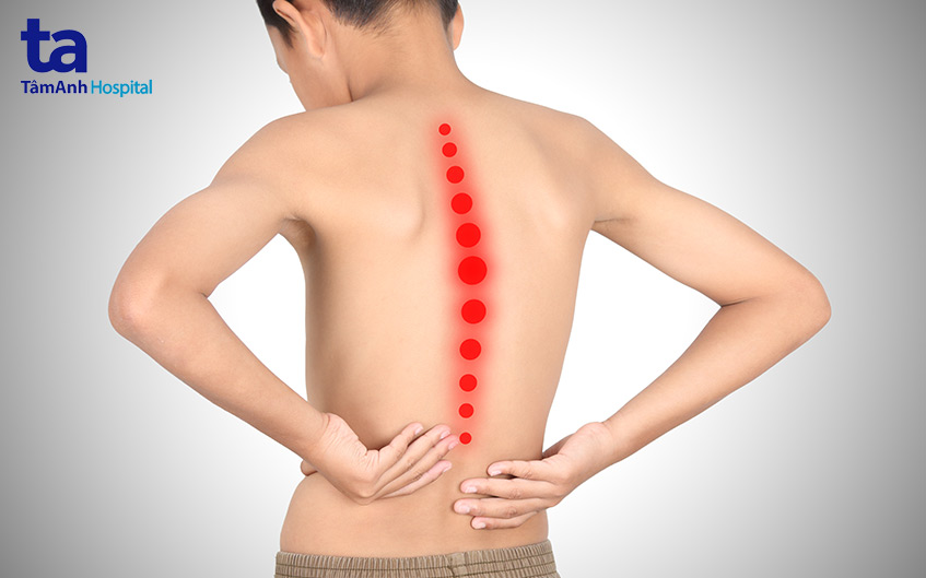 khiến trẻ bị đau và cứng lưng