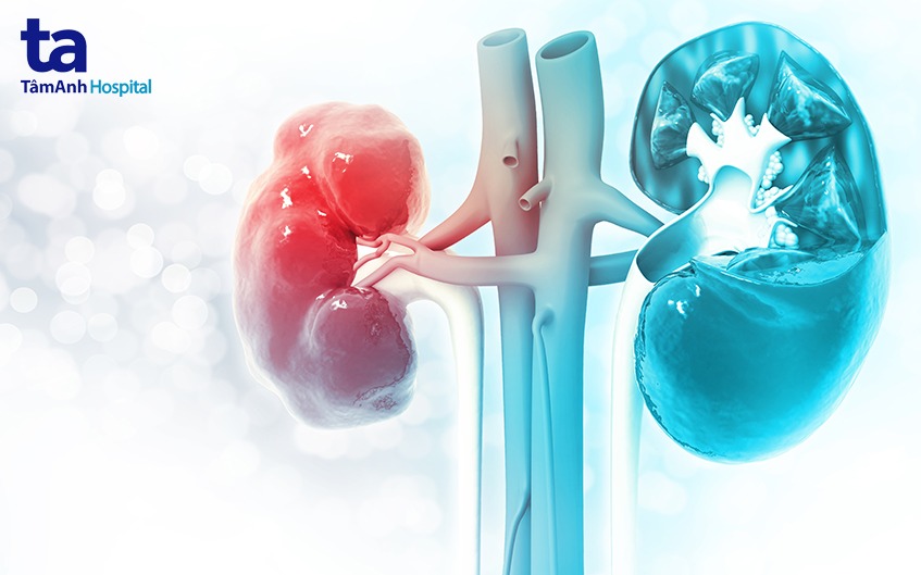 suy thận mạn giai đoạn cuối