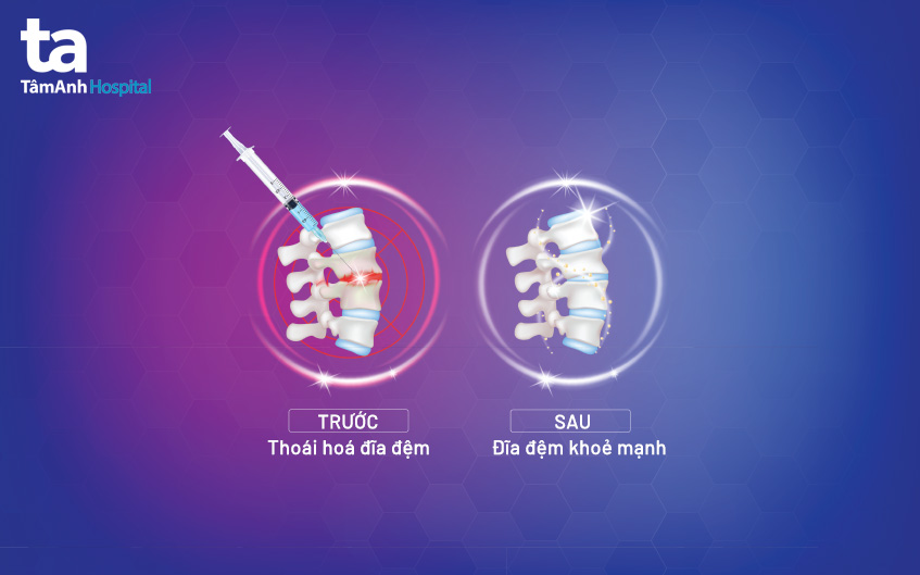 tiêm steroid ngoài màng cứng
