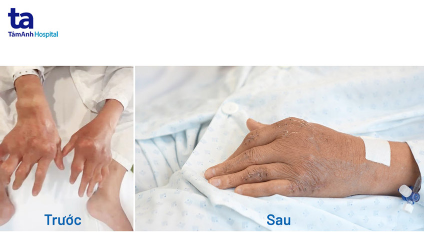 trước và sau khi điều trị