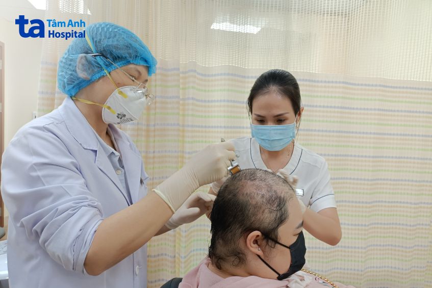 bác sĩ đang lăn kim điều trị rụng tóc cho người bệnh