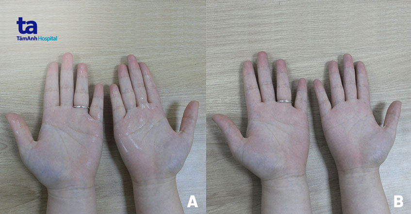 bàn tay ra nhiều mồ hôi