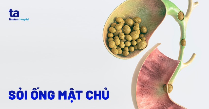 bệnh sỏi ống mật chủ