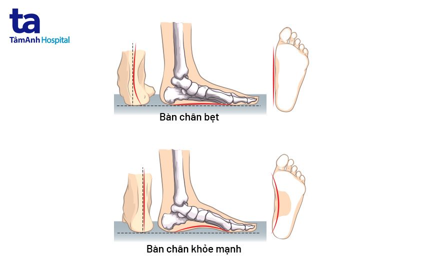 cách nhận biết bàn chân bẹt ở trẻ em