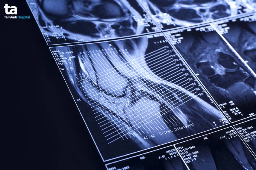 chi phí mri khớp gối