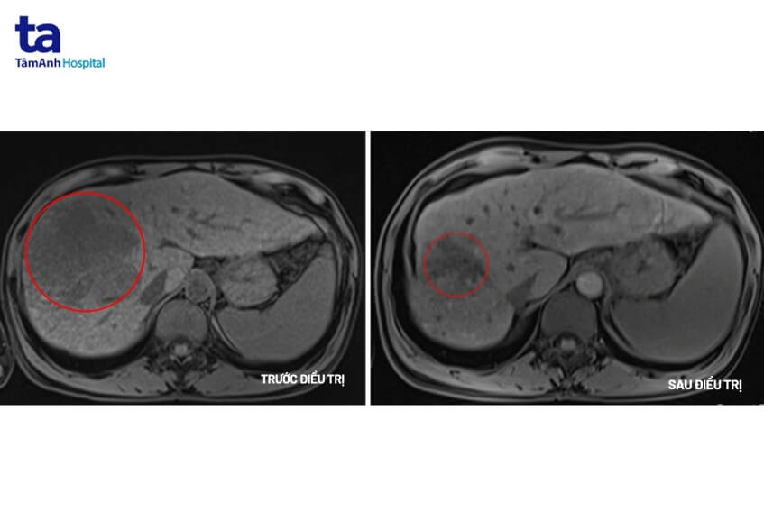 hình ảnh chẩn đoán đau tức hạ sườn