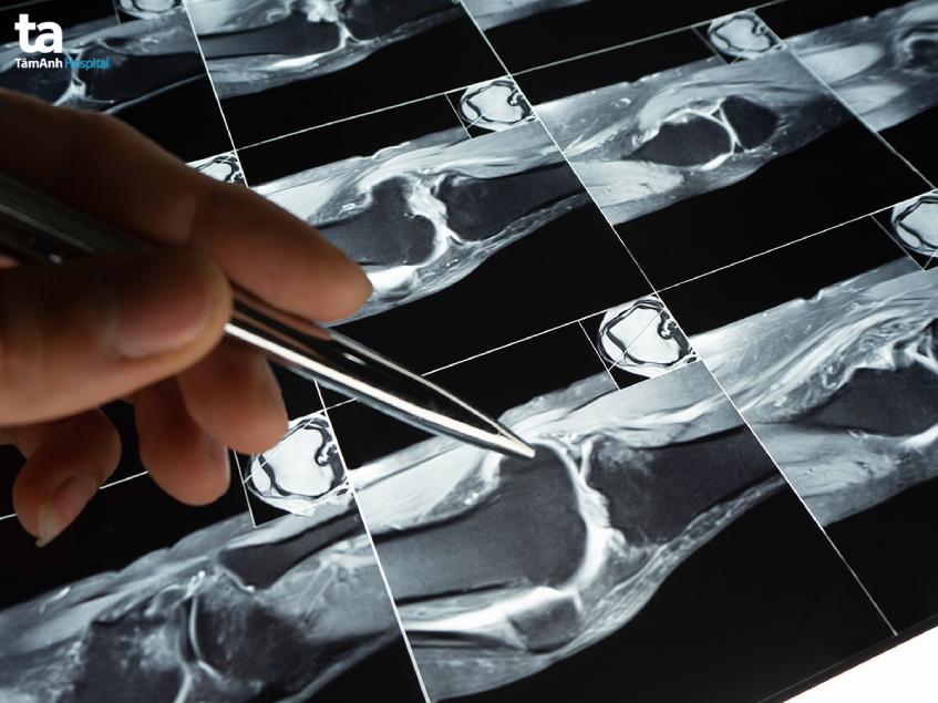 khi nào cần mri khớp gối