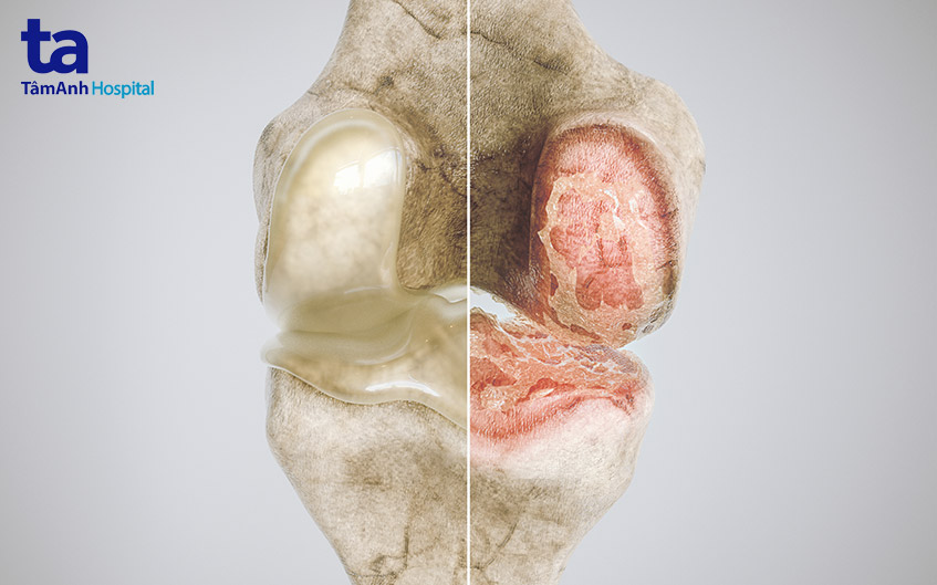 khiến khớp gối bị thoái hóa