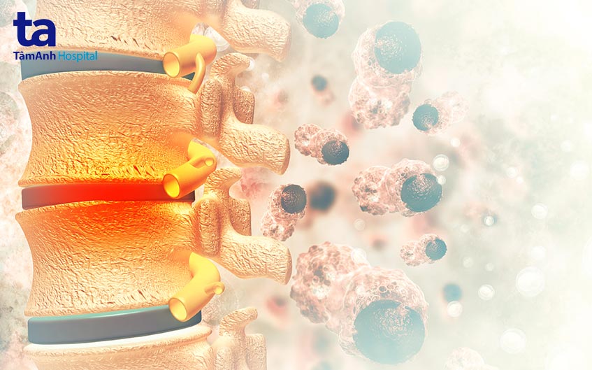 khối u xương ác tính