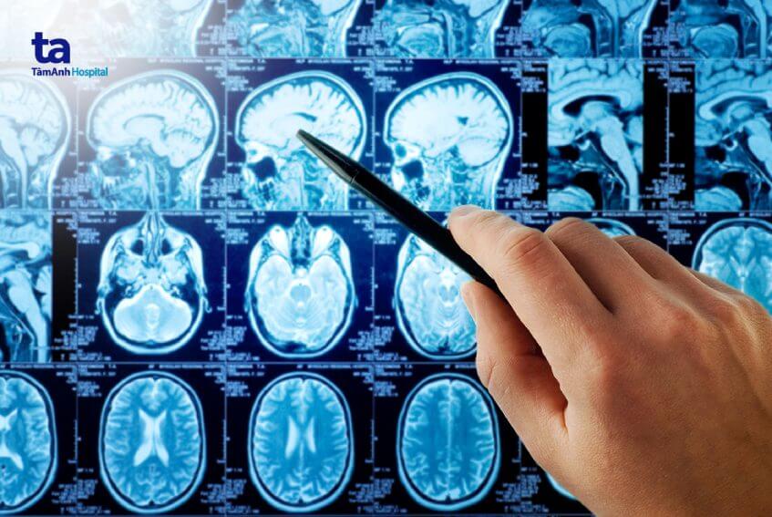 lựa chọn phương pháp điều trị u tuyến tùng