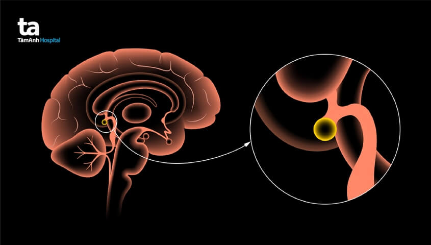 mô phỏng khối u tuyến tùng