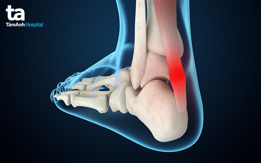 một số vấn đề ở gân gót chân