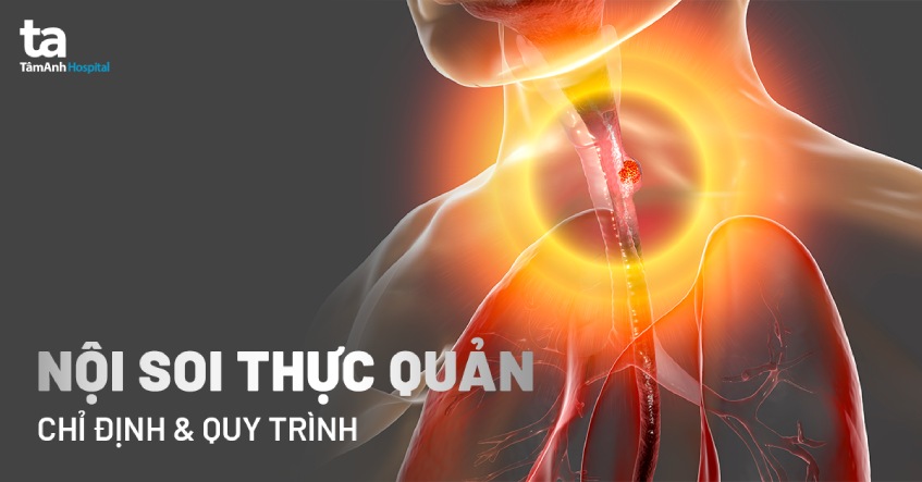 nội soi thực quản là gì 
