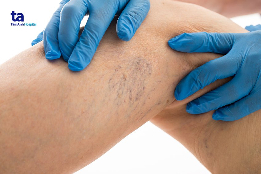 siêu âm mạch máu phát hiện bệnh gì