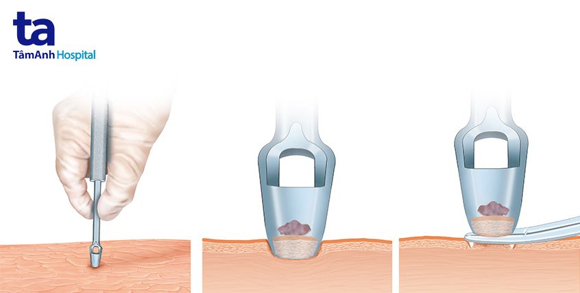 sinh thiết và chọc hút tủy xương