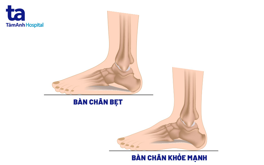 so sánh bàn chân bình thường và bàn chân bẹt