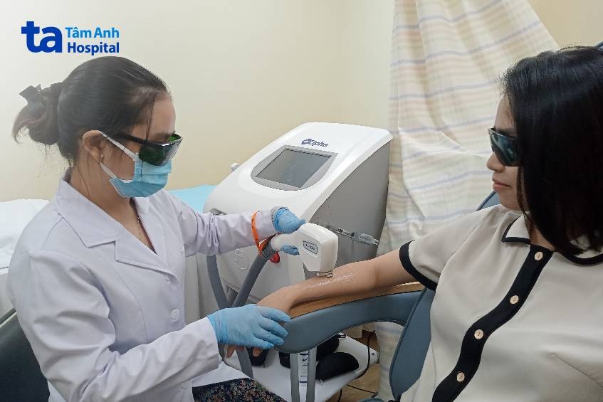 triệt lông với công nghệ diode laser