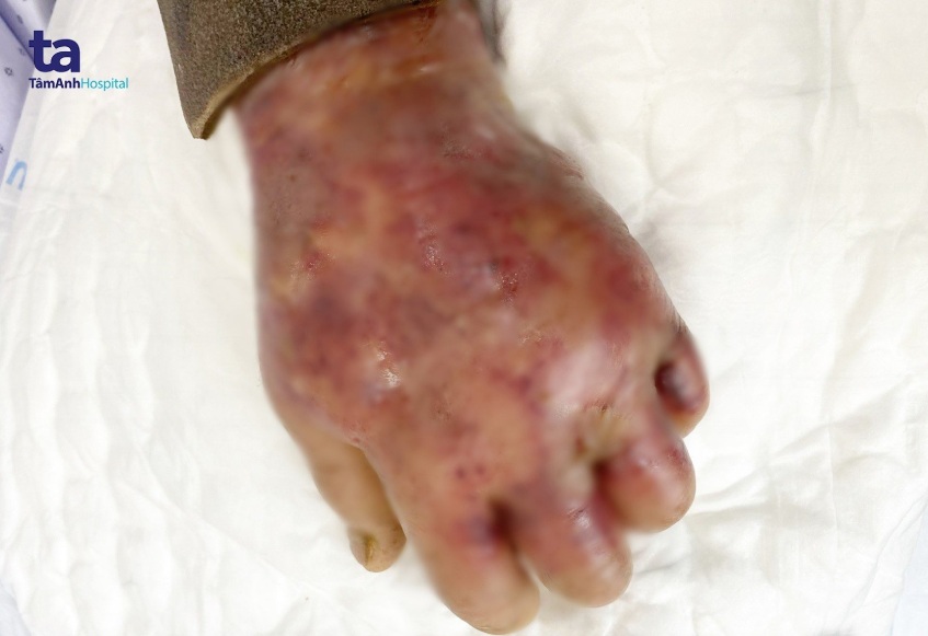 Vùng mu bàn tay và cẳng tay trái sưng đỏ