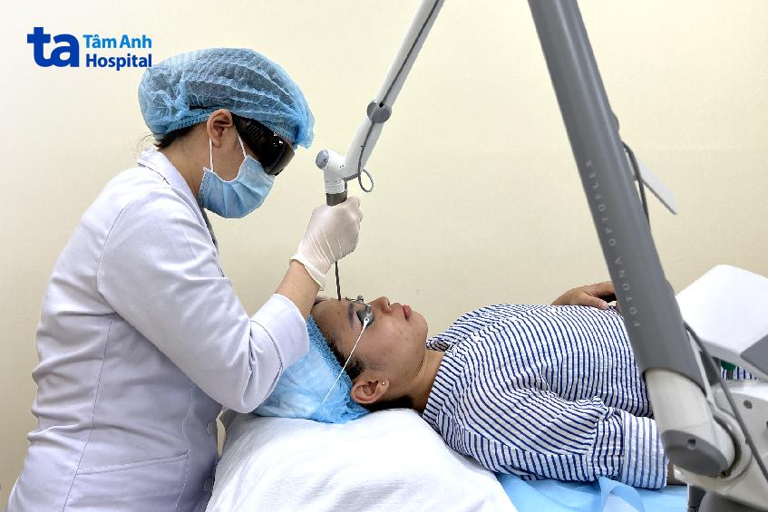 xóa nám tàn nhang bằng công nghệ laser pico nhập khẩu