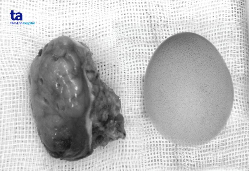 amidan to như quả trứng gà