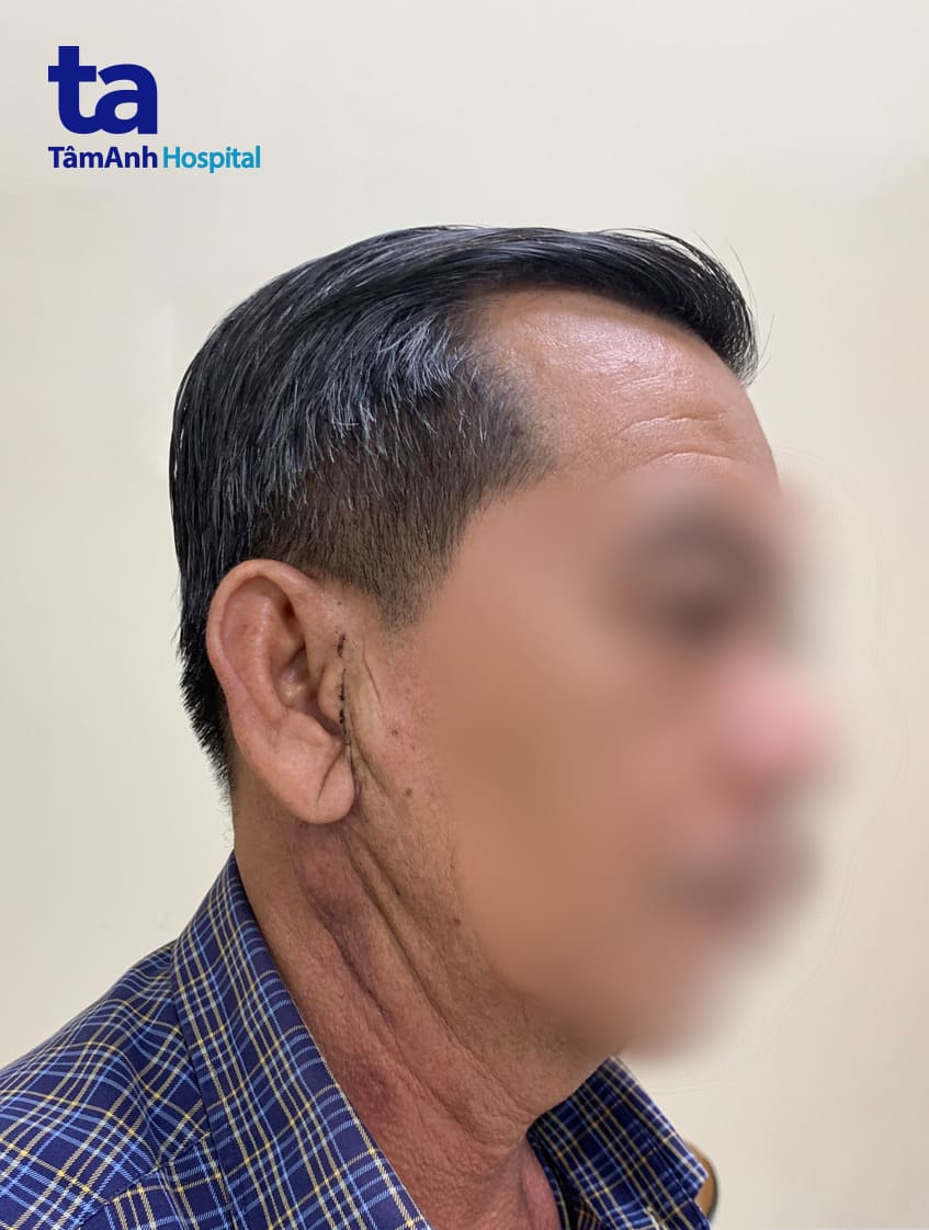 Ăn uống ngay sau vài giờ mổ