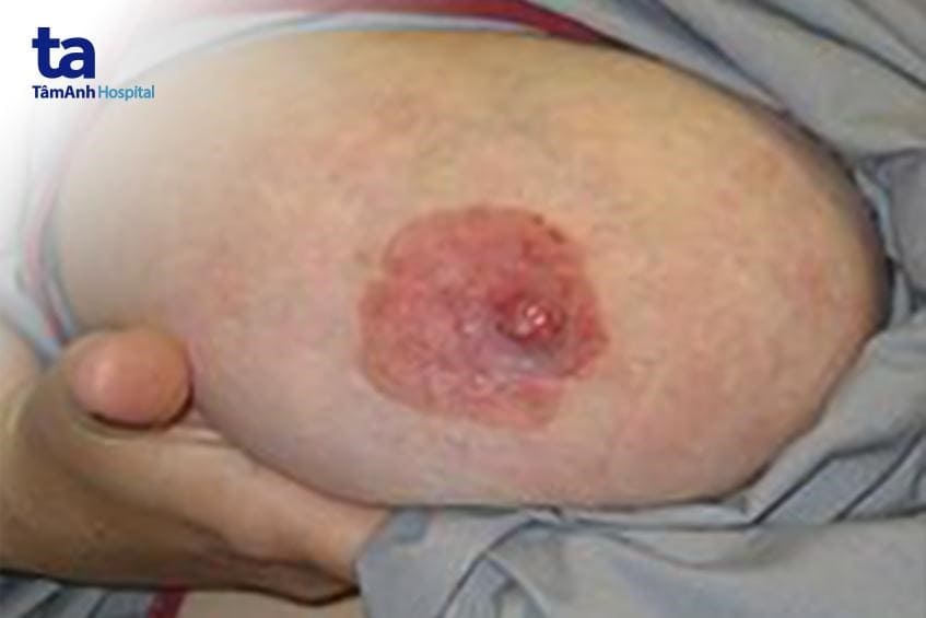 Bệnh paget núm vú