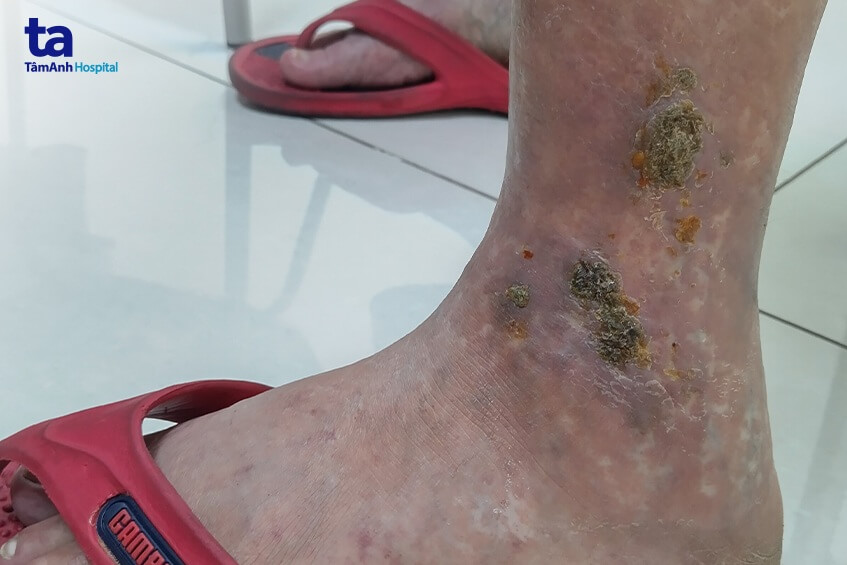 chị n da chân xơ cứng như gỗ