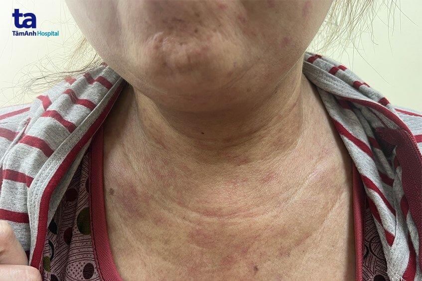 chị n da chân xơ cứng như gỗ