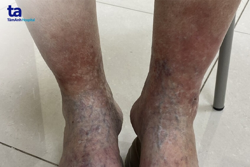 da chân xơ cứng như gỗ