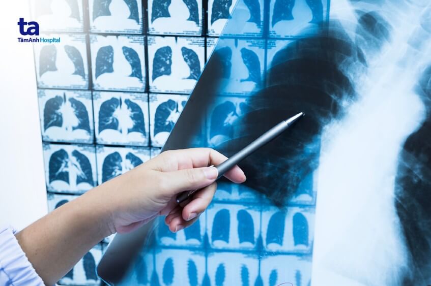 hình ảnh ung thư phổi không tế bào nhỏ giai đoạn 2