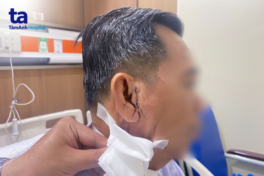 Kết thúc phẫu thuật u tuyến mang tai