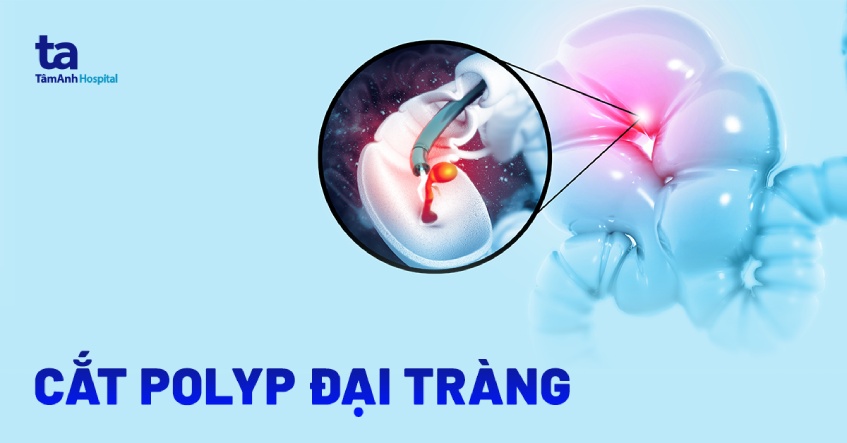 mổ polyp đại tràng