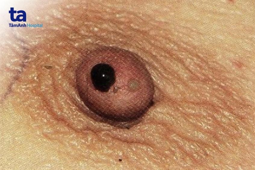 nguyên nhân khác có thể gây tiết dịch núm vú