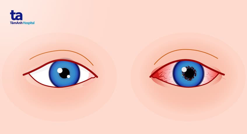 Nguyên nhân viêm mống mắt thể mi