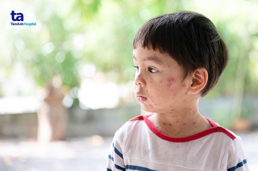 Nốt thủy đậu lan rộng ở vùng cổ và mặt của trẻ
