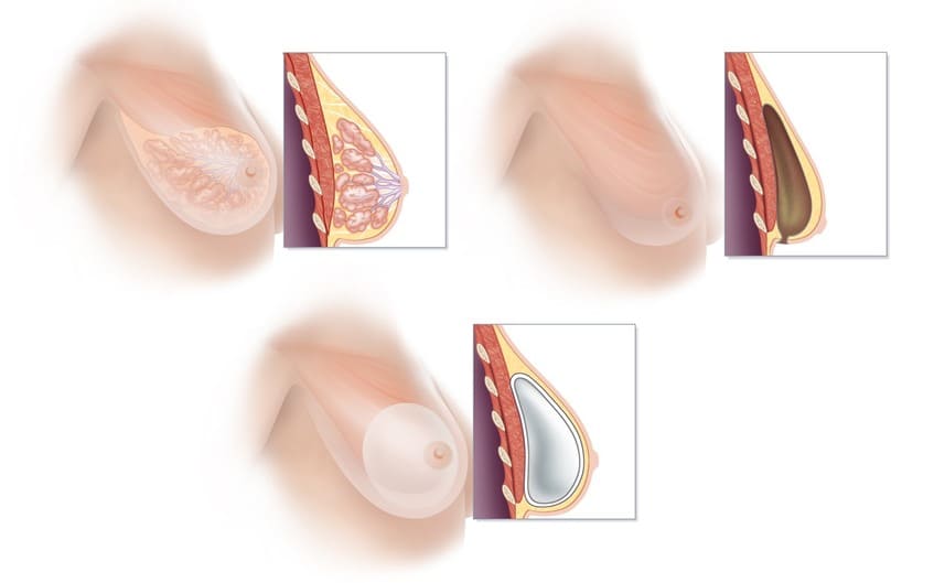 tái tạo túi cơ ngực