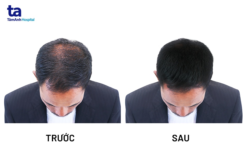 Rụng tóc ở nam giới Nguyên nhân dấu hiệu điều trị và chẩn đoán