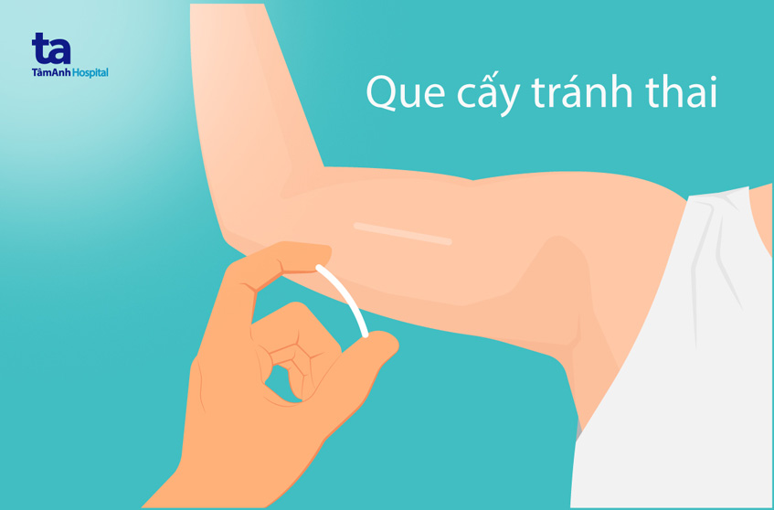 que tránh thai được cấy dưới da cánh tay