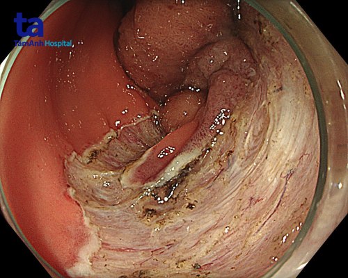 sau cắt polyp