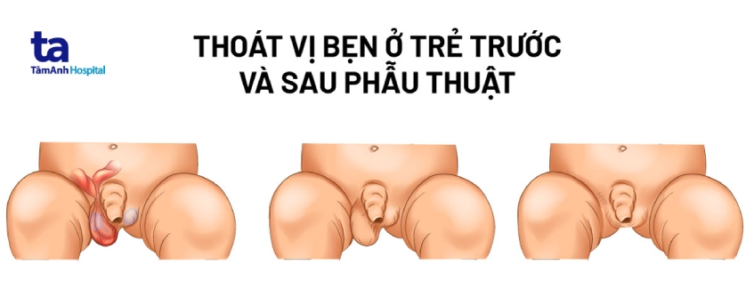 Thoát vị bẹn ở trẻ trước và sau phẫu thuật
