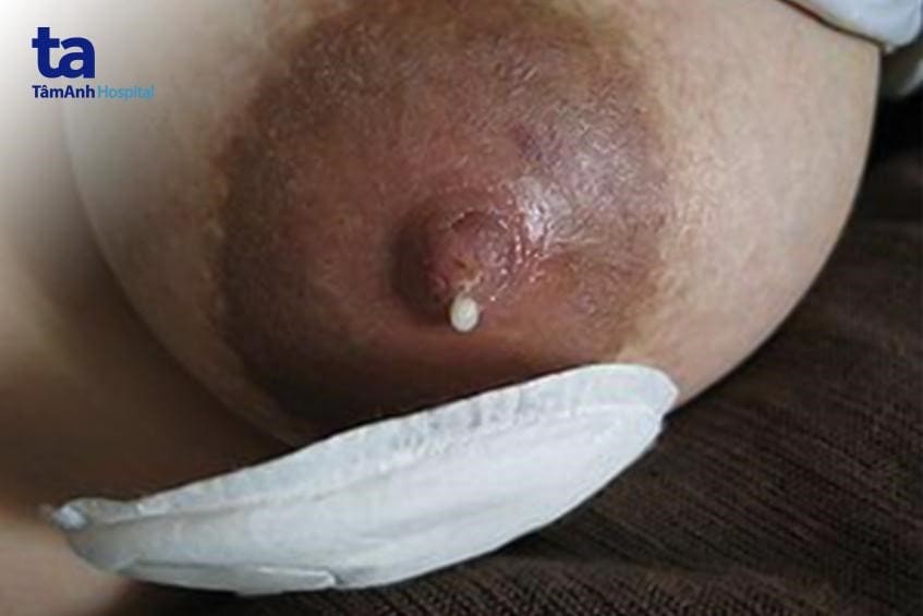 tiết dịch núm vú sữa, lành tính