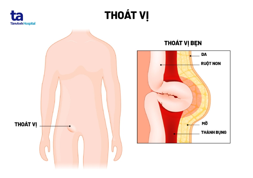 Trẻ xuất hiện một khối tròn bất thường ở vùng bẹn