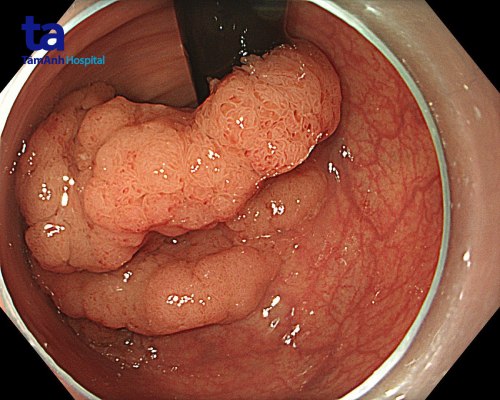 trước cắt polyp