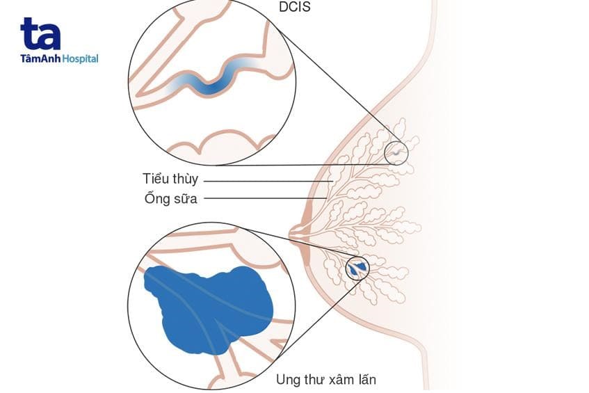 Ung thư trong ống dẫn sữa