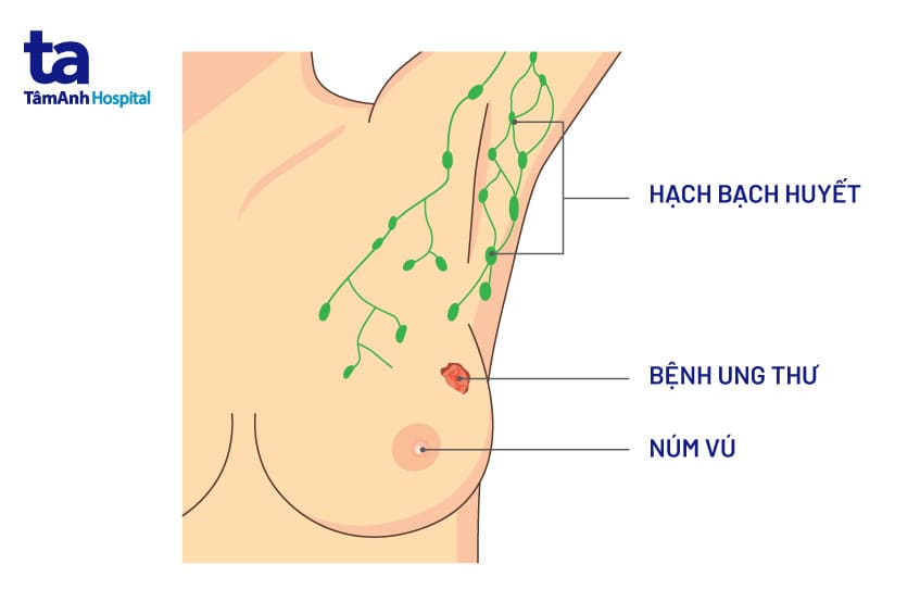 Các loại ung thư vú phổ biến
