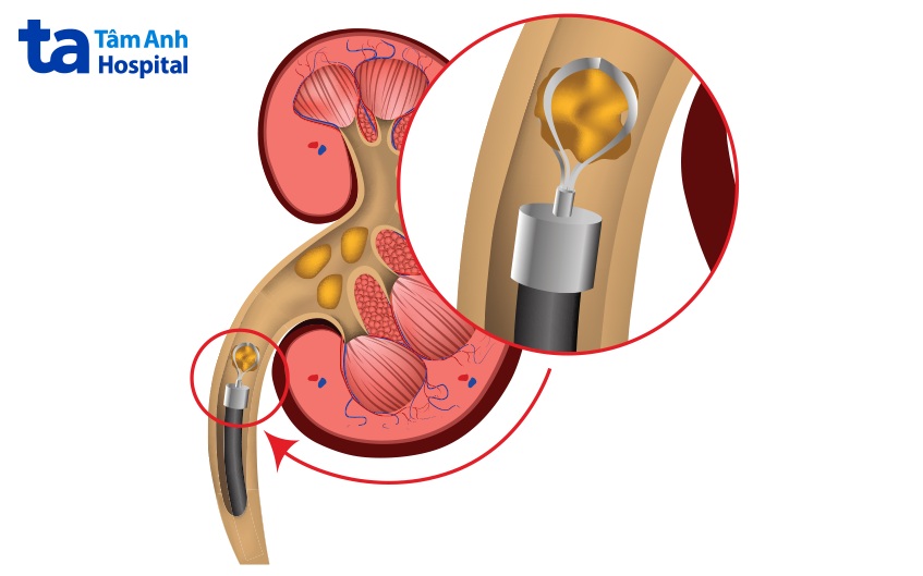chữa trị sỏi niệu quản