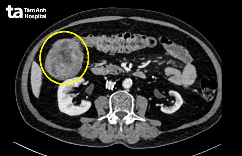 Hình ảnh khối u đại tràng qua chụp cắt lớp CT