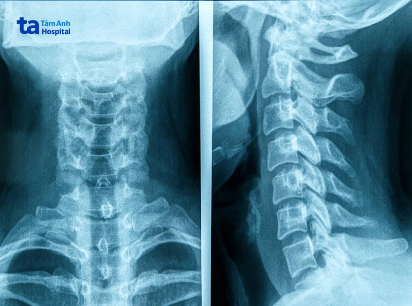 cột sống cổ x quang