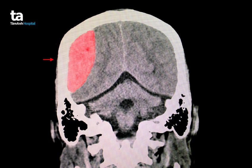 điều trị tụ máu não
