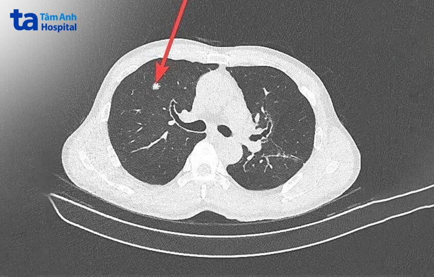 Hình ảnh nốt phổi trên phim chụp CT 768 lát cắt.